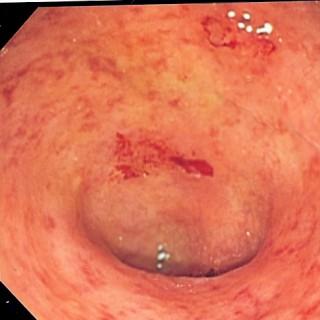 Ulcerative colitis